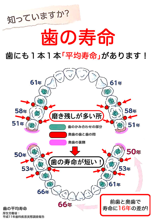 歯の寿命