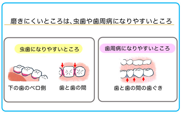 磨きにくいところは虫歯や歯周病になりやすいところ