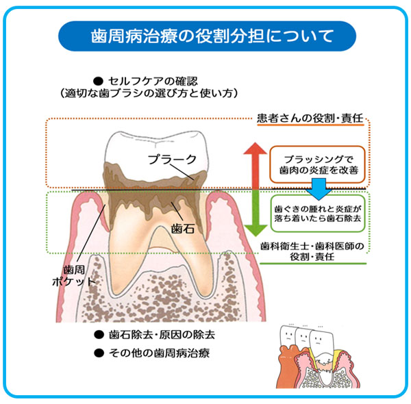 歯周病治療の役割分担について